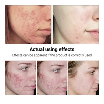 acnee anti-imbatranire a pielii