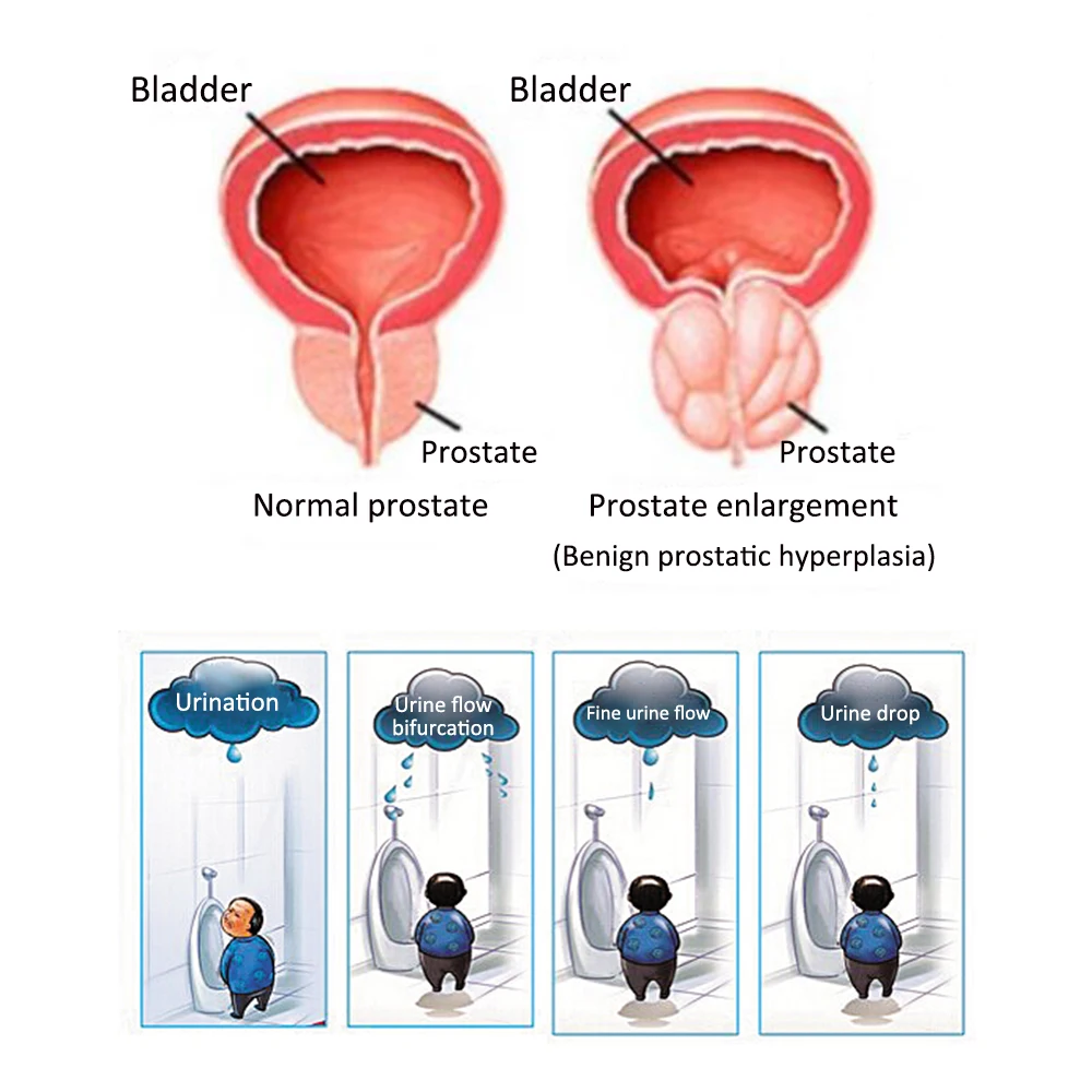 Misan Med Hipertrofia Benigna de Prostata (HBP) - Misan Med