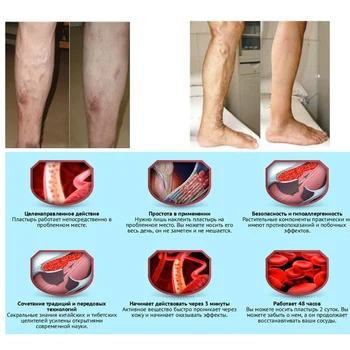 varicoza i energie varicoza de hemoragie pe picioare